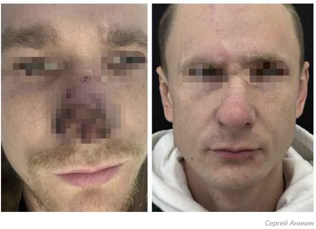 Откушенный зверем нос охотника восстановлен благодаря благовещенскому хирургу