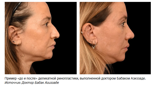 Роскошь ринопластики, которую никто не замечает.