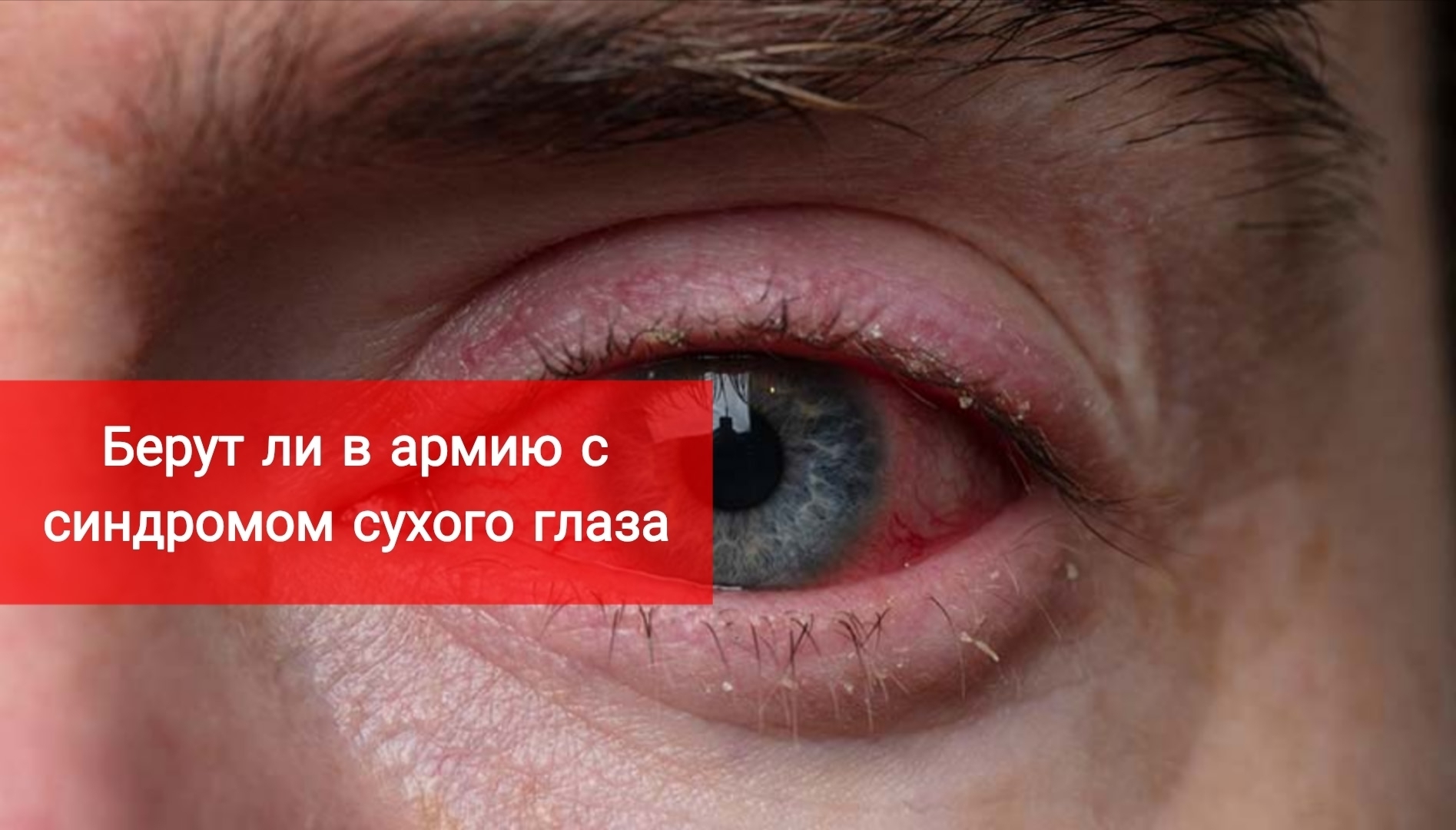 Берут ли в армию с синдромом сухого глаза?