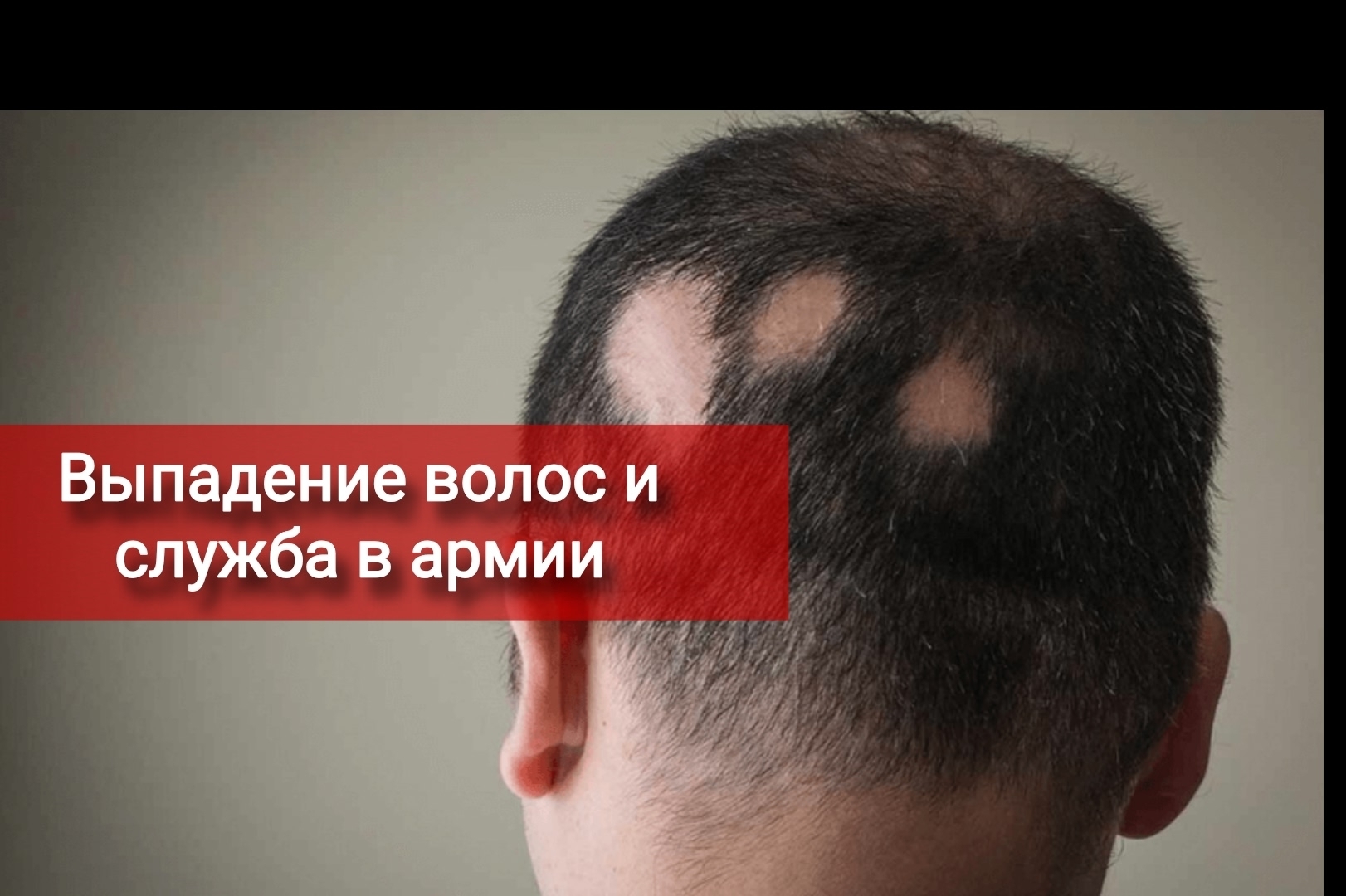 Выпадение волос и служба в армии
