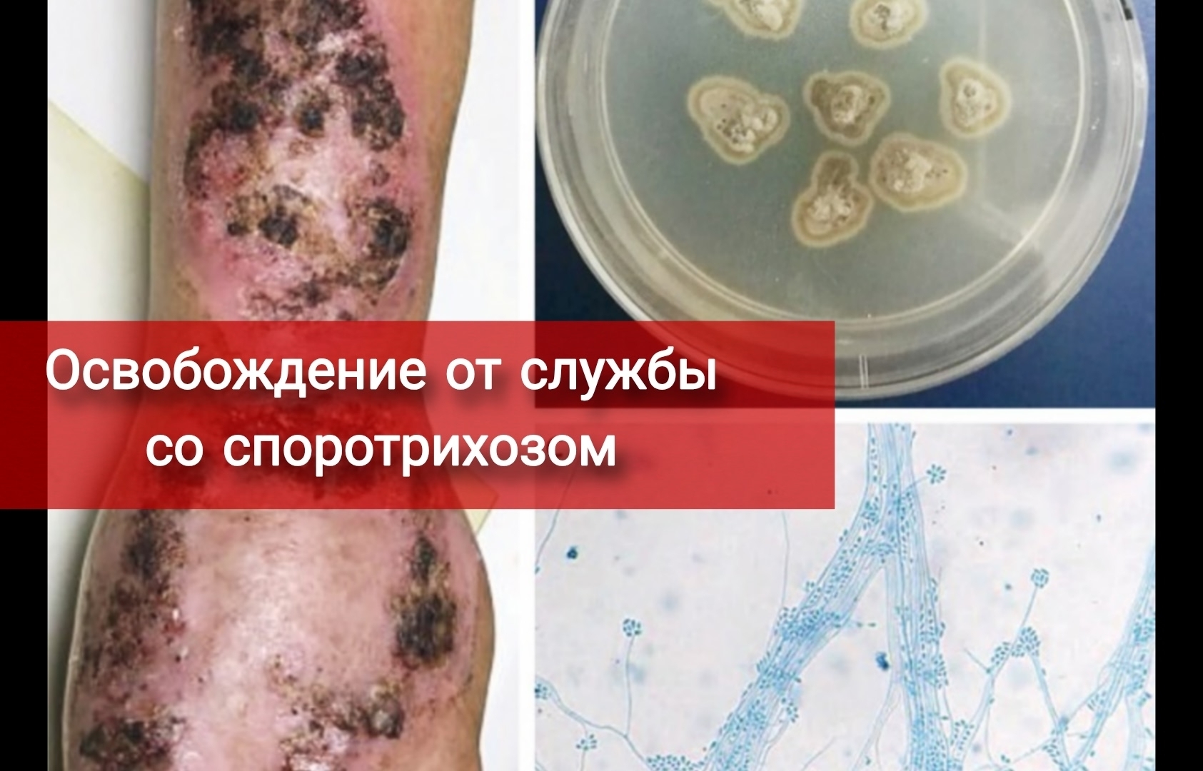 Освобождение от армии со споротрихозом