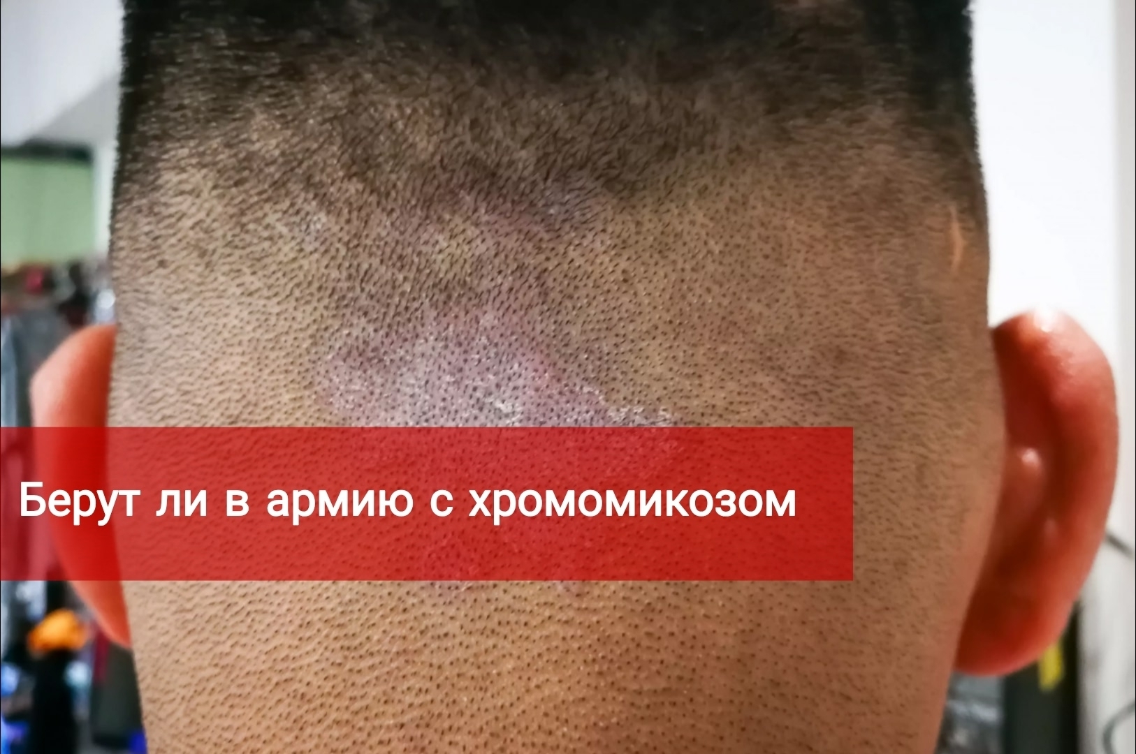 Берут ли в армию с хромомикозом?